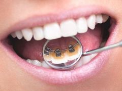 Güzel gülüşlerin sırrı koruyucu ortodonti olabilir!